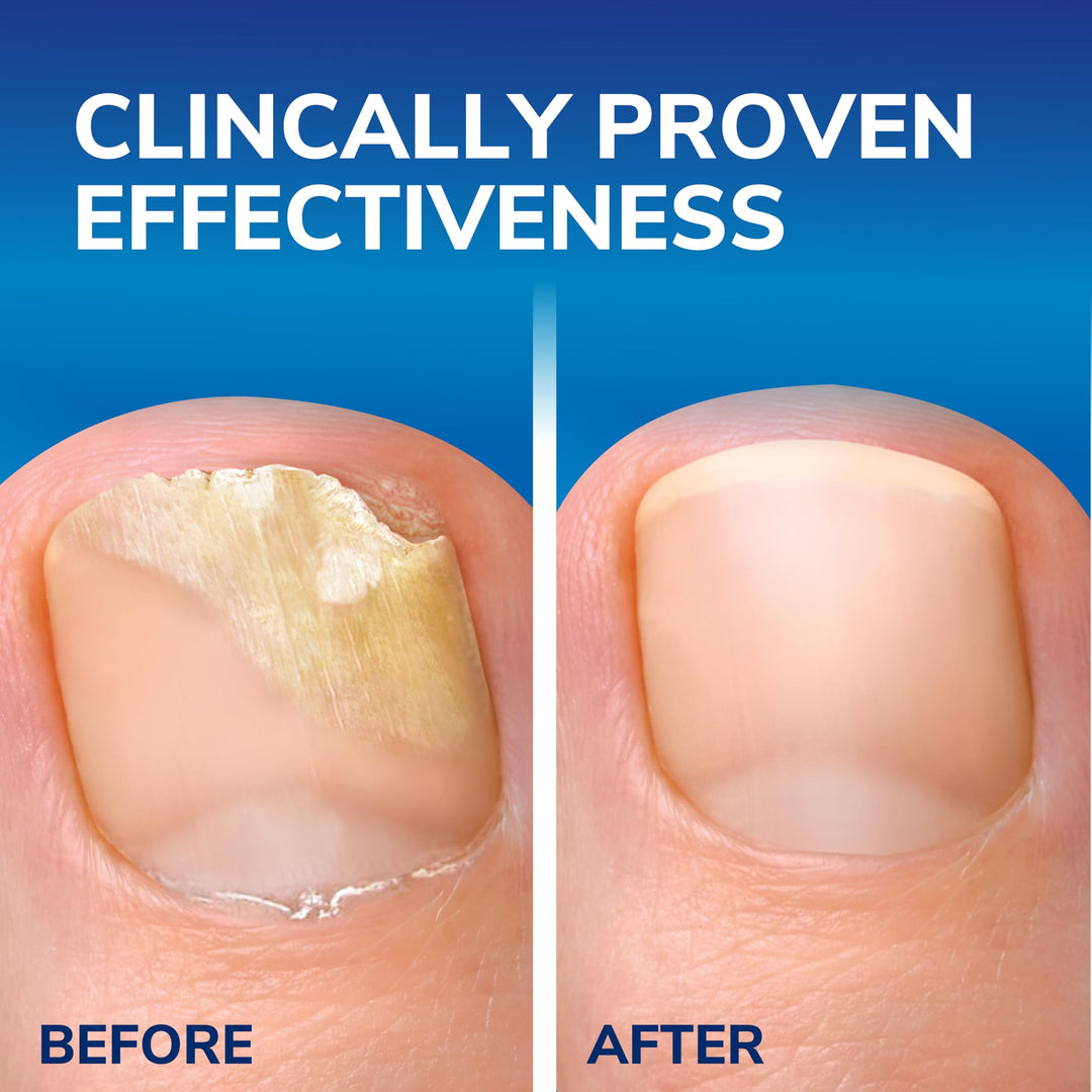 Scholl anti-fungal nail treatment kit with file and brush applicator for targeted care